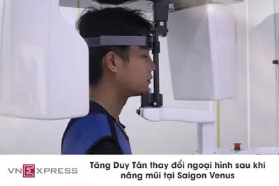 Nâng mũi tại Sài Gòn venus