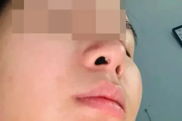 Lộ sụn tai đầu mũi có nguy hiểm không?