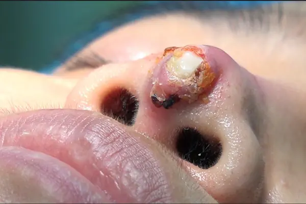 Lộ sụn tai đầu mũi, dấu hiệu và cách khắc phục