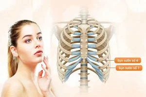 Nâng mũi sụn sườn toàn phần thực hiện như thế nào?